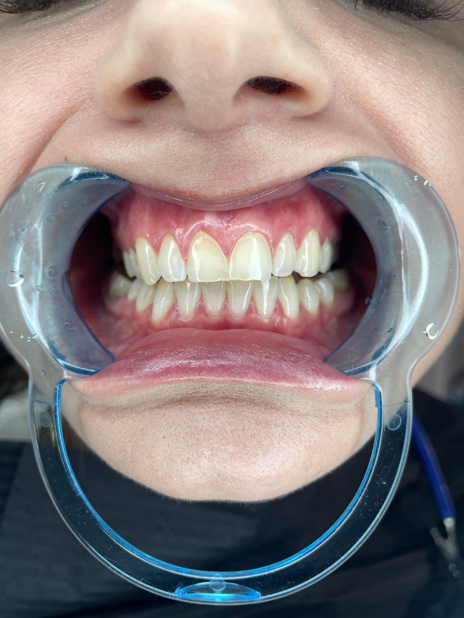 Dental checkup at Willow Creek Dental