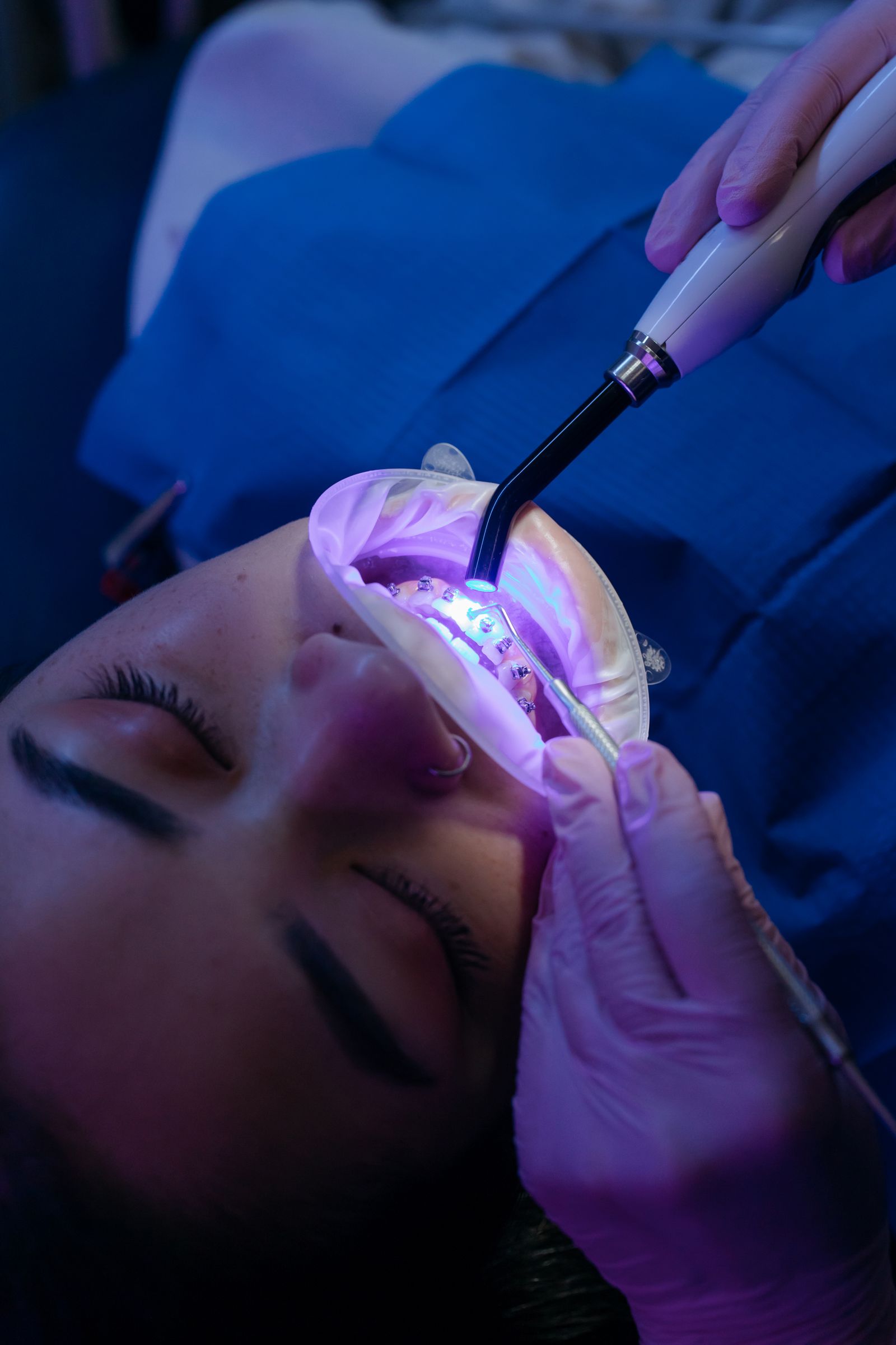 Cosmetic whitening treatment